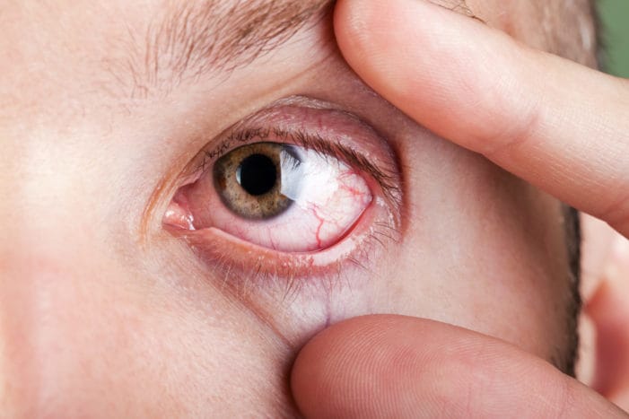 الفيتامينات للعيون الجافة