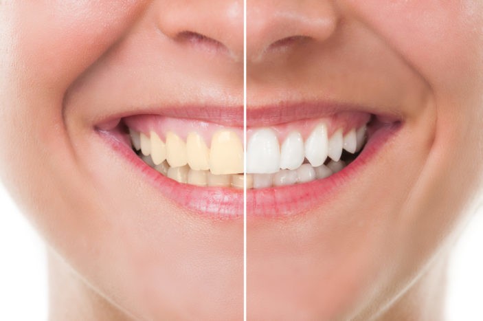 الآثار الجانبية للأسنان تبييض مع التبييض