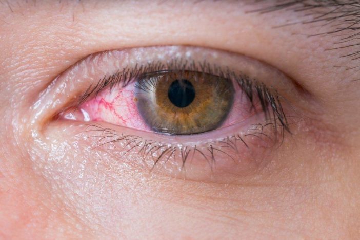 حساسية العين الحمراء ملتحمة العين